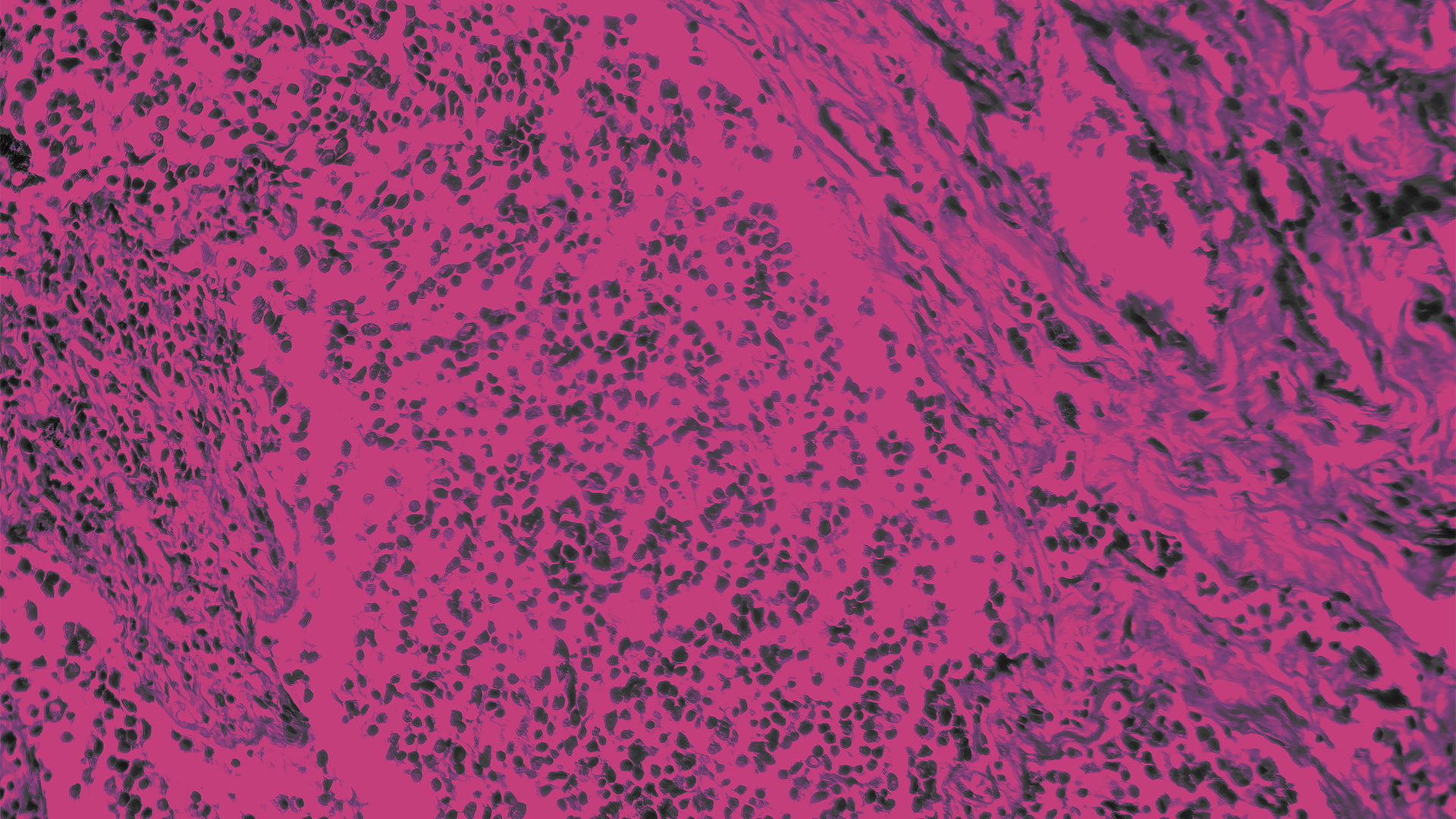 Small cell lung cancer, light micrograph