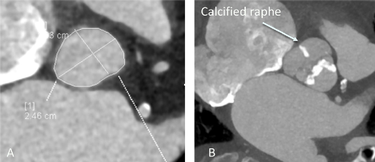 15_27_Figure 1_escardio-hPhotoLarge.jpg