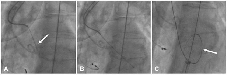 v14n5_Prendergast_Figure_1_Technical aspects of transcatheter aortic valve implantation.jpg