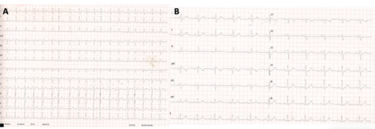 Picture1 Clinical case CCVG insights Vol13_escardio-hPhotoLarge.png