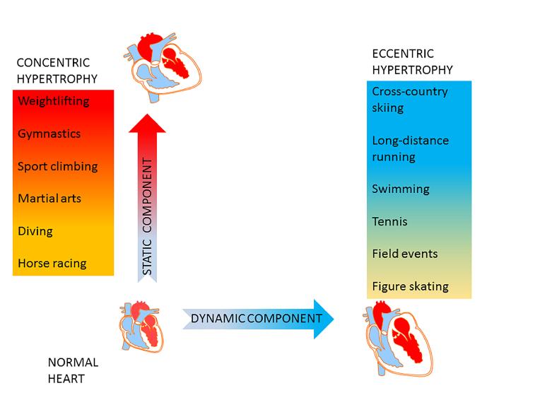 14_35_Figure 1_Heart failure in athletes.jpg