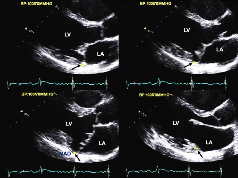 341_Essayagh_FOR AUTHOR APPROVAL_Figure 3_escardio-hPhotoLarge.jpg
