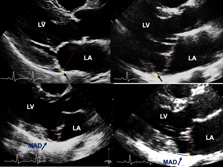341_Essayagh_FOR AUTHOR APPROVAL_Figure 1_escardio-hPhotoLarge.jpg