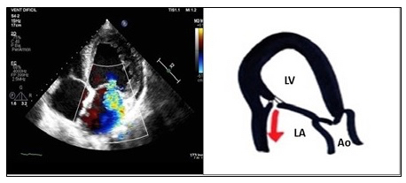 135_Lacalzada-Almeida_Figure 1- Ischaemic mitral valve regurgitation.jpg
