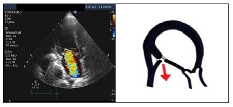 135_Lacalzada-Almeida_Figure 2-Ischaemic mitral valve regurgitation.jpg
