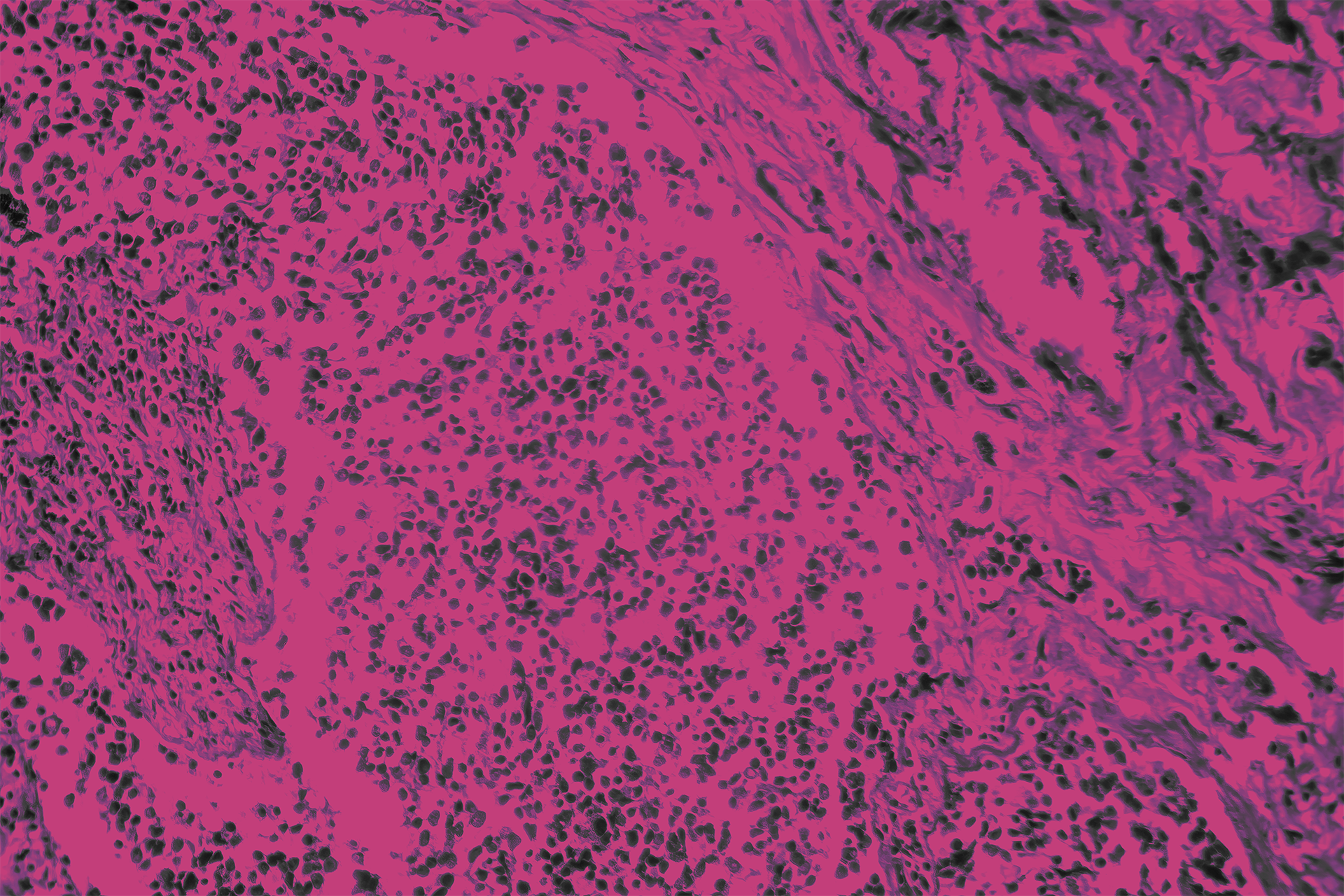 Small cell lung cancer, light micrograph