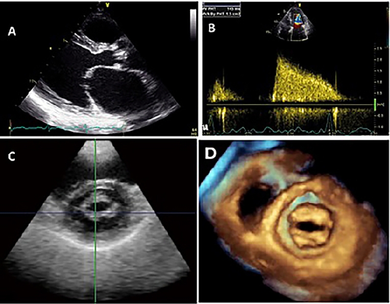 151_Anwar_Figure 2.FINAL_Understanding the role of echocardiography in the assessment of mitral valve disease.jpg