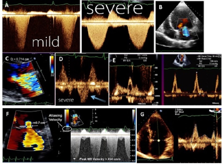 151_Anwar_Figure 1_FINAL_Understanding the role of echocardiography in the assessment of mitral valve disease.jpg