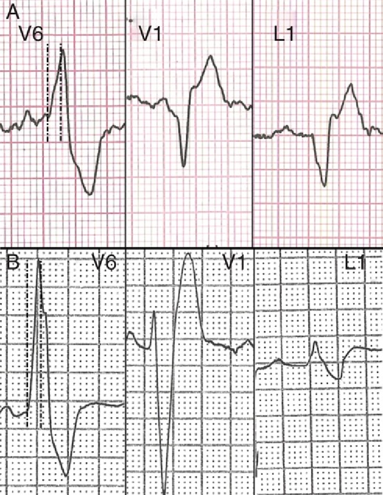 182_Ibarrola_Figure 3_Ventricular extrasystoles in athletes.jpg