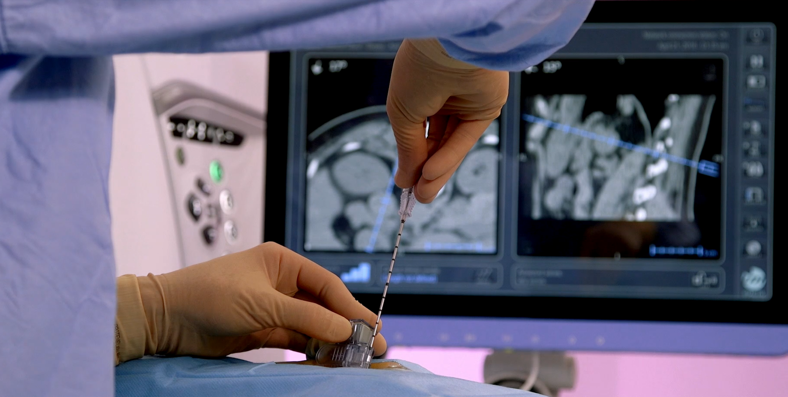 Procedure using IMACTIS 3D CT-navigation system