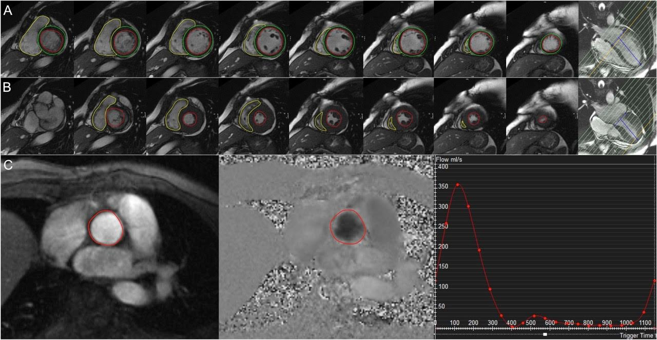 138_LaRocca_Figure 1-Mitral regurgitation a rapidly growing epidemic.jpg
