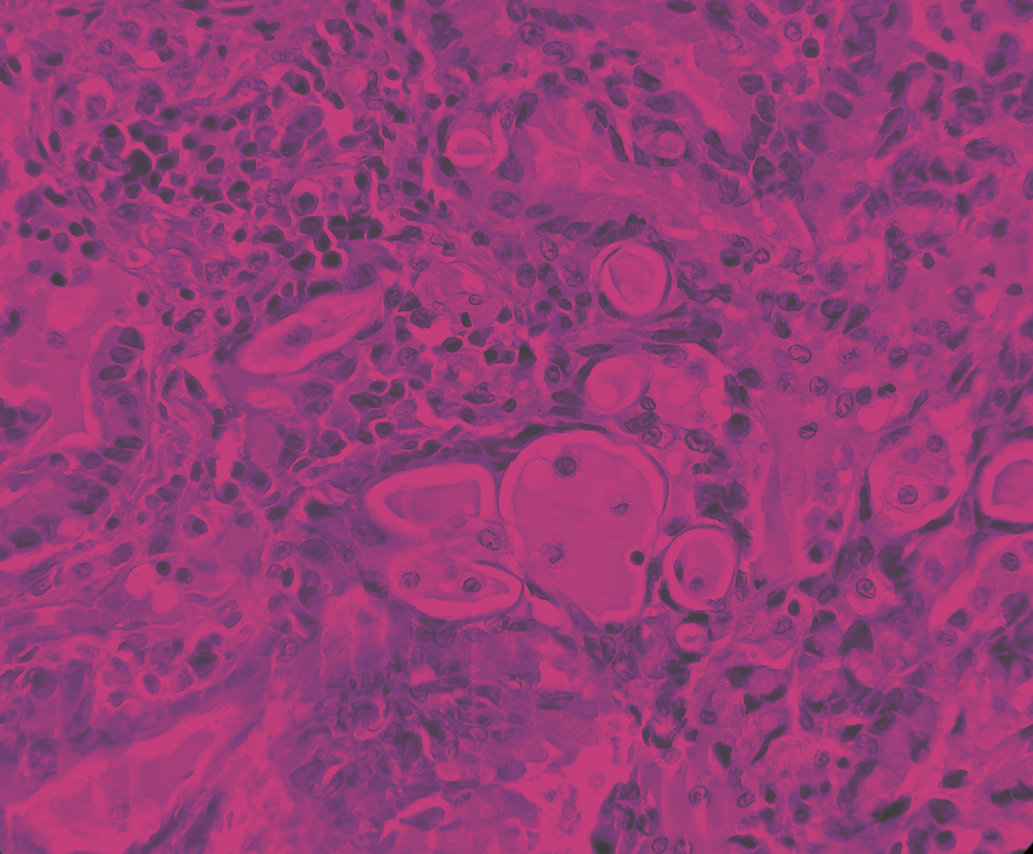 Lung cancer_766060478_pink.jpg