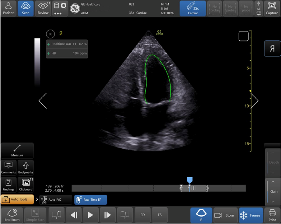 Real-time Ejection Fraction tool in action (GE HealthCare)