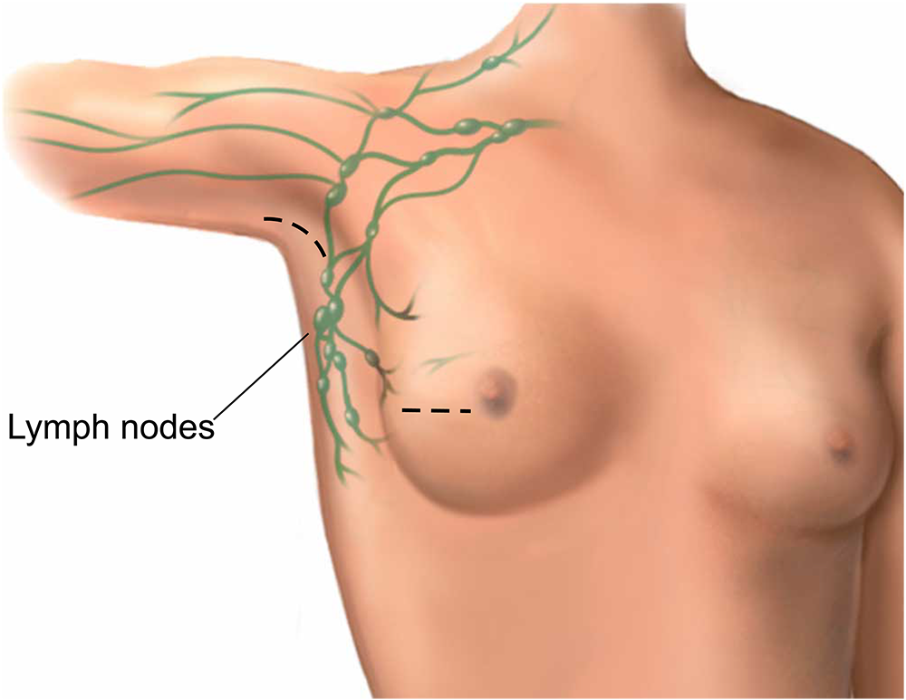 An illustration showing cuts for a wide local excision and axillary surgery.