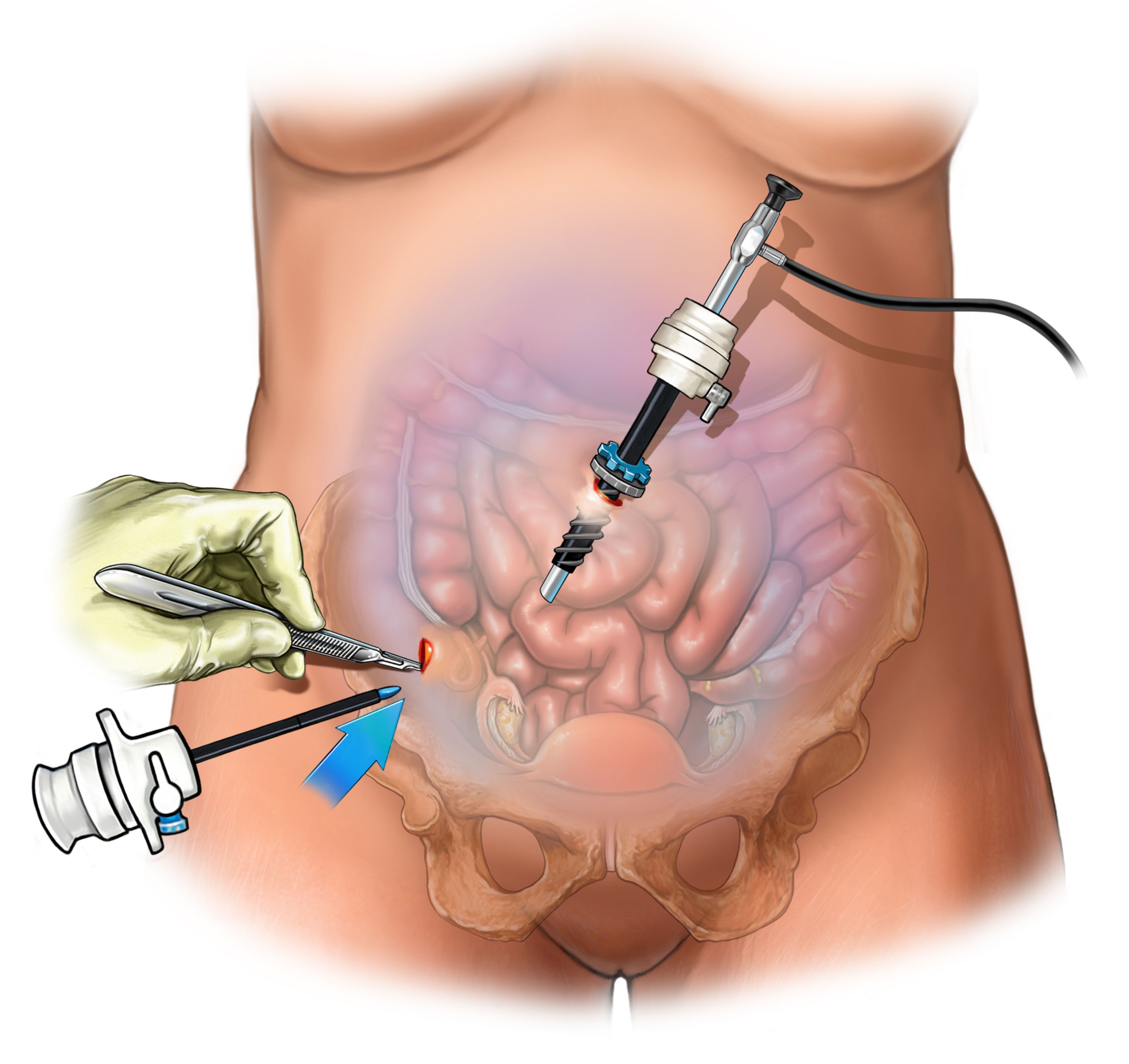 illustration of a laproscopy