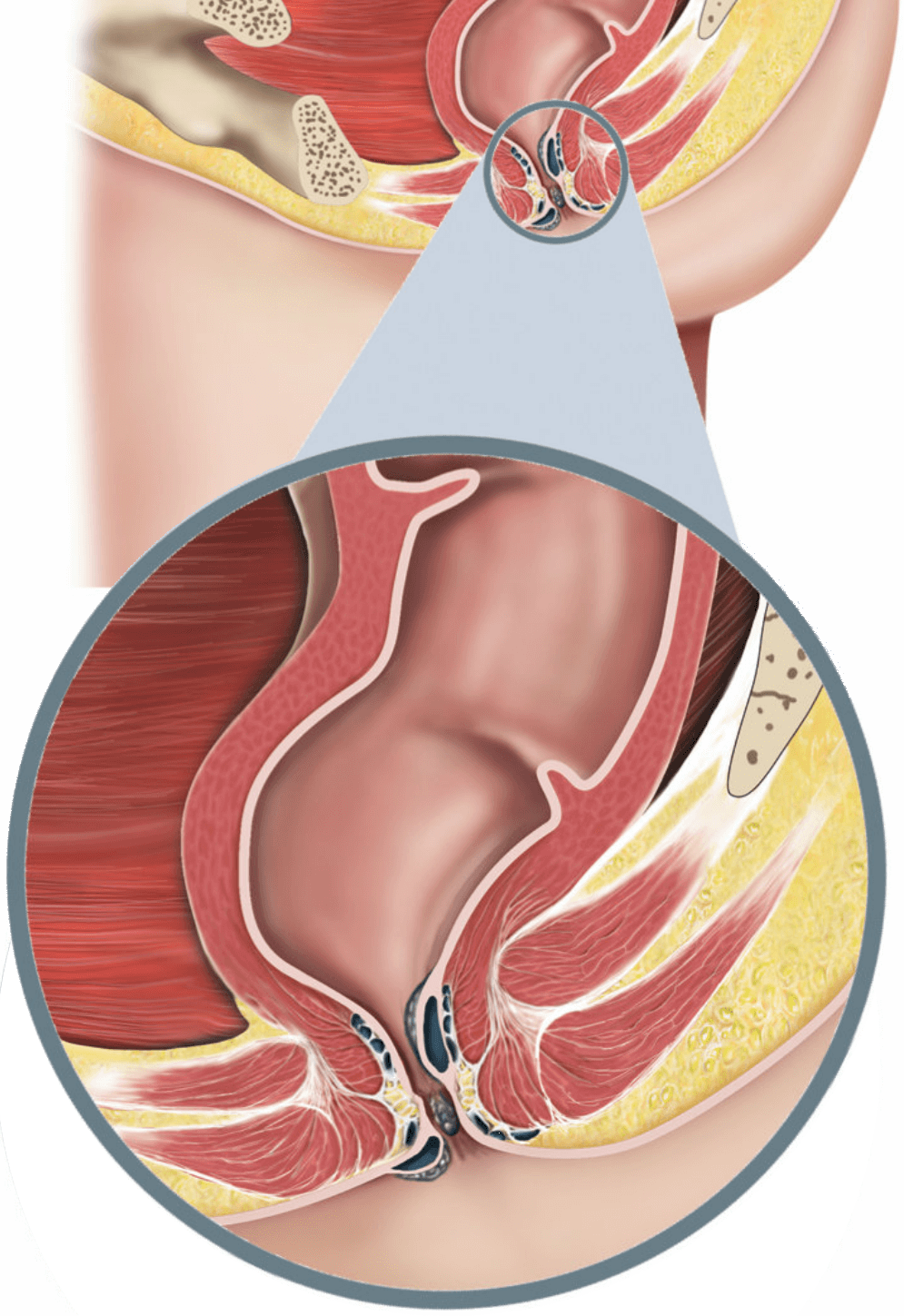 Illustration showing haemorrhoids in the anal canal.