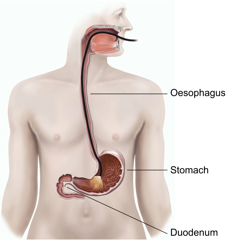 Illustration showing an upper GI endoscopy.