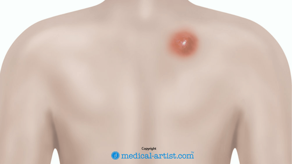 Illustration showing a raised, swollen abscess on the upper right area of the back.