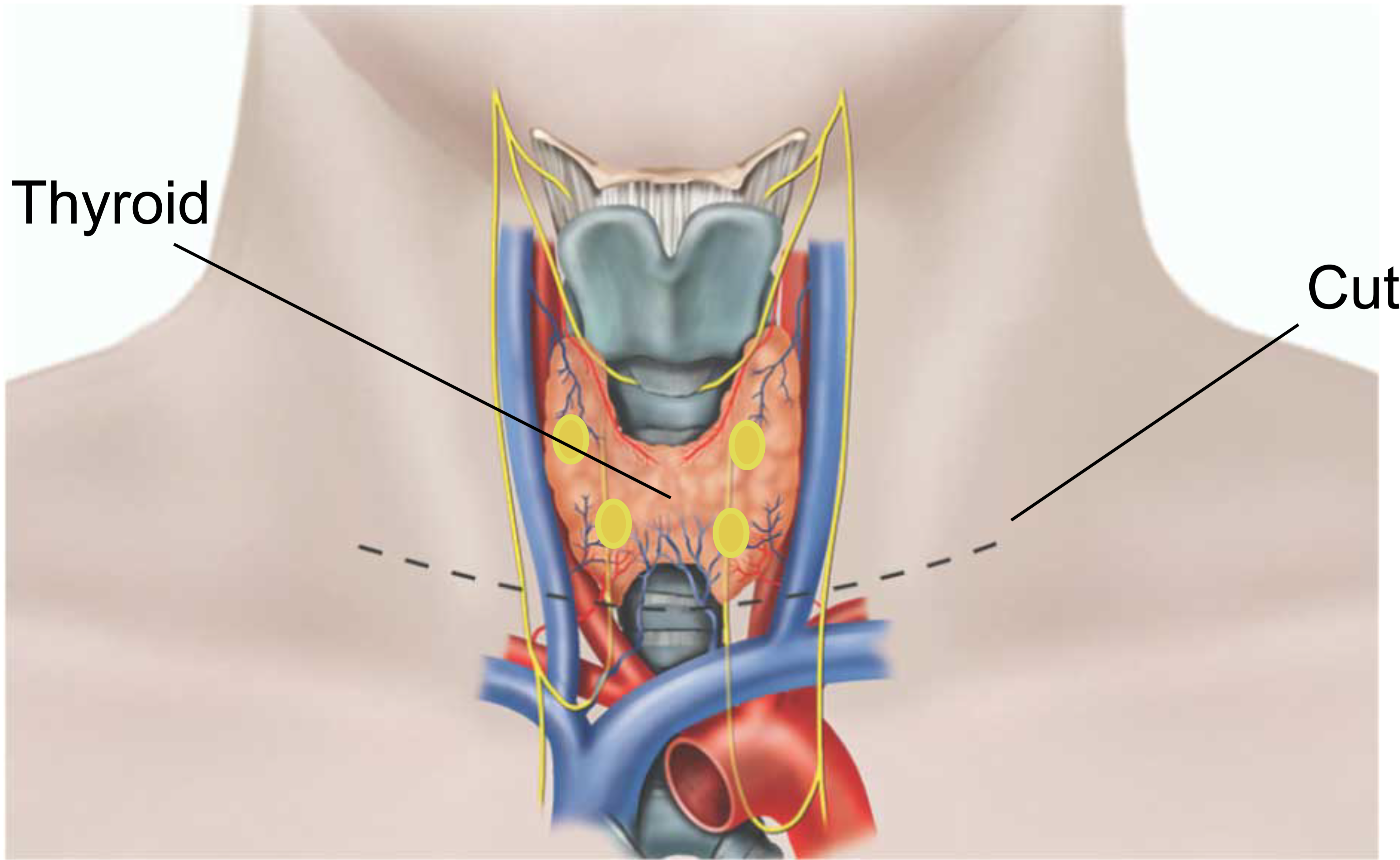 The thyroid and lines showing where the cuts will be made.