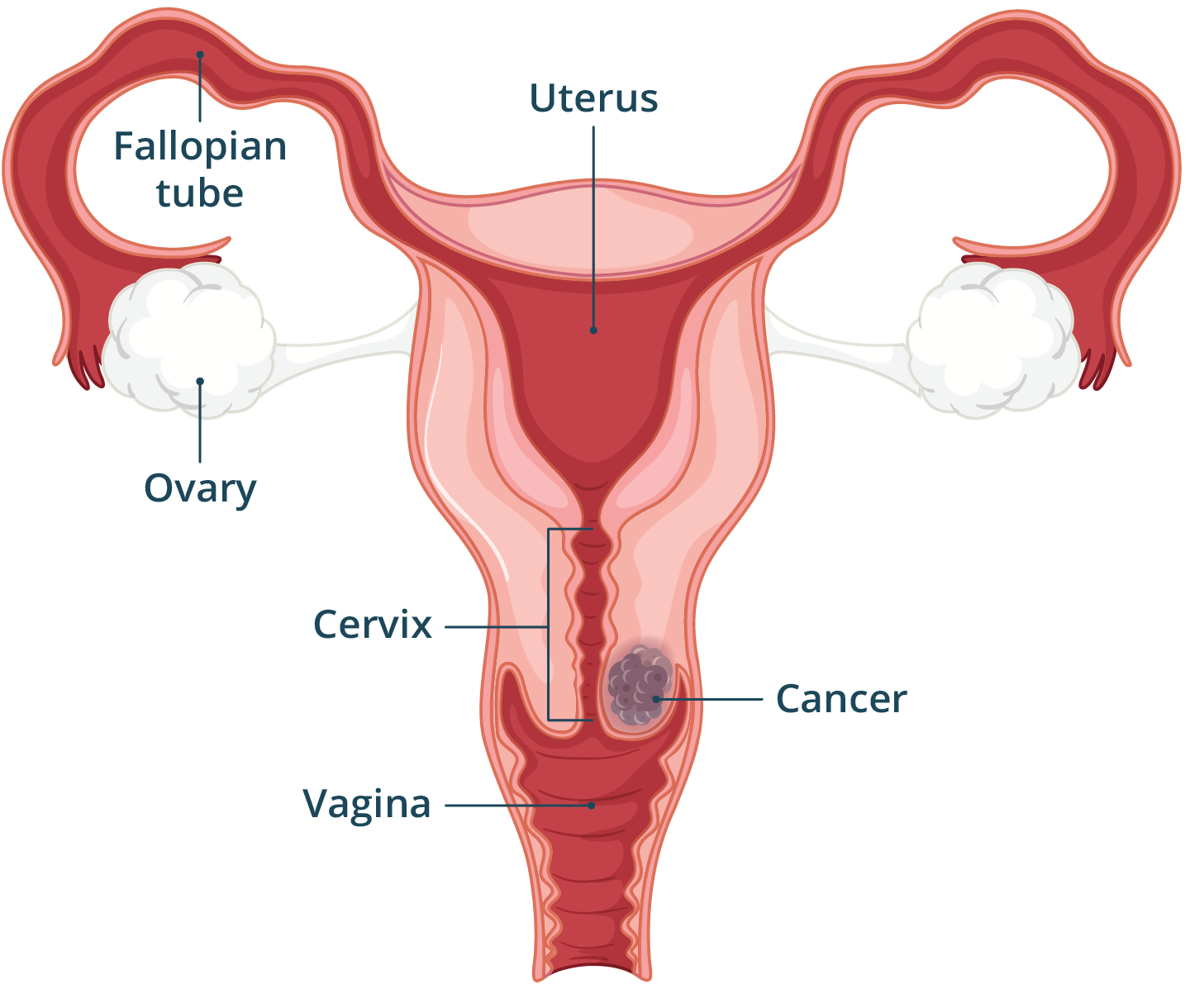 Illustration of the female reproductive system showing a cancerous mass in the cervix.