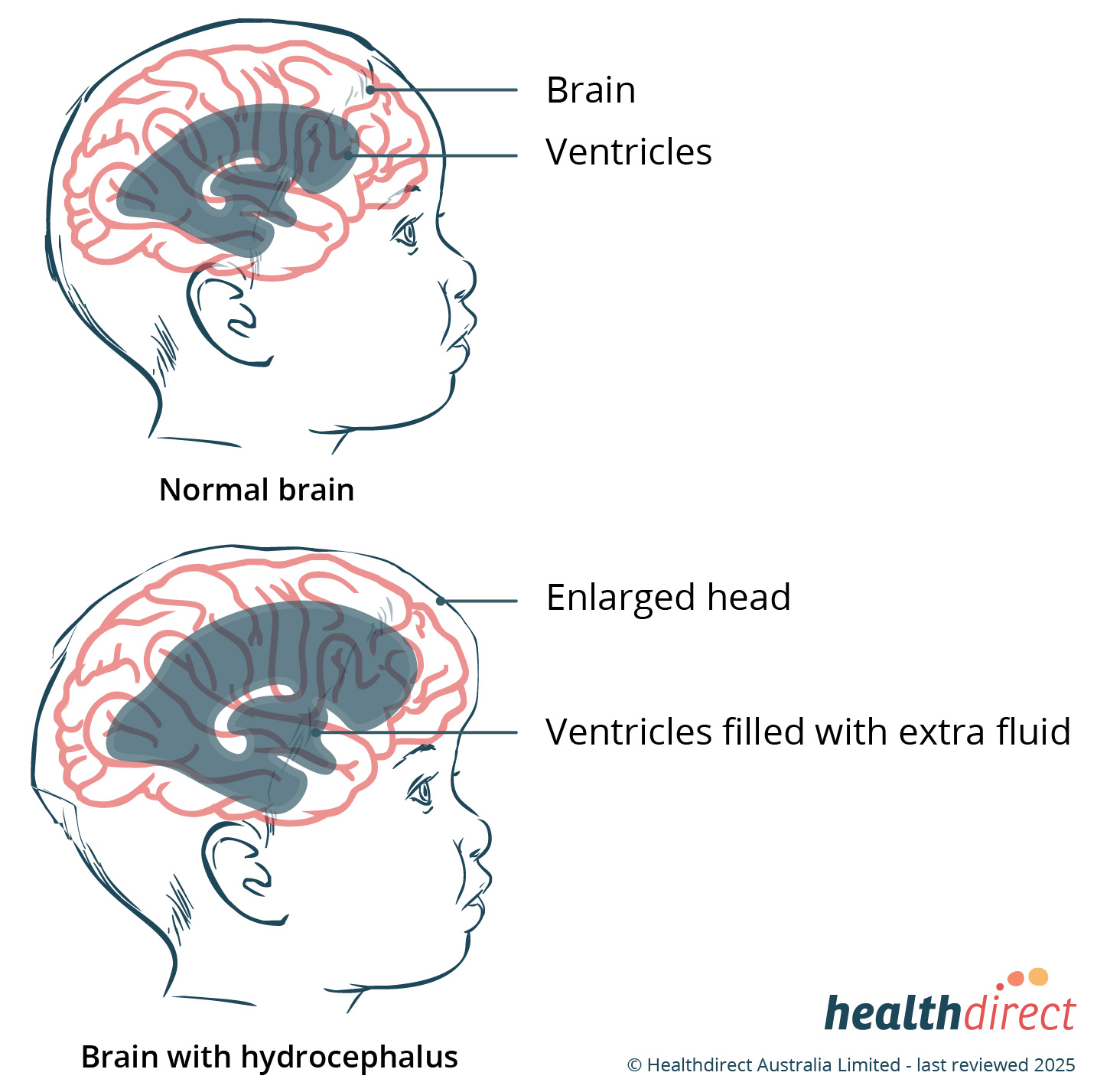 A diagram showing a normal brain and a brain with hydrocephalus.