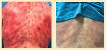 When Larry Hart first came to Moffitt, his body was covered with painful lesions that had been misdiagnosed as common skin issues. With the right treatment, his cancer is now under control and the scars are fading.