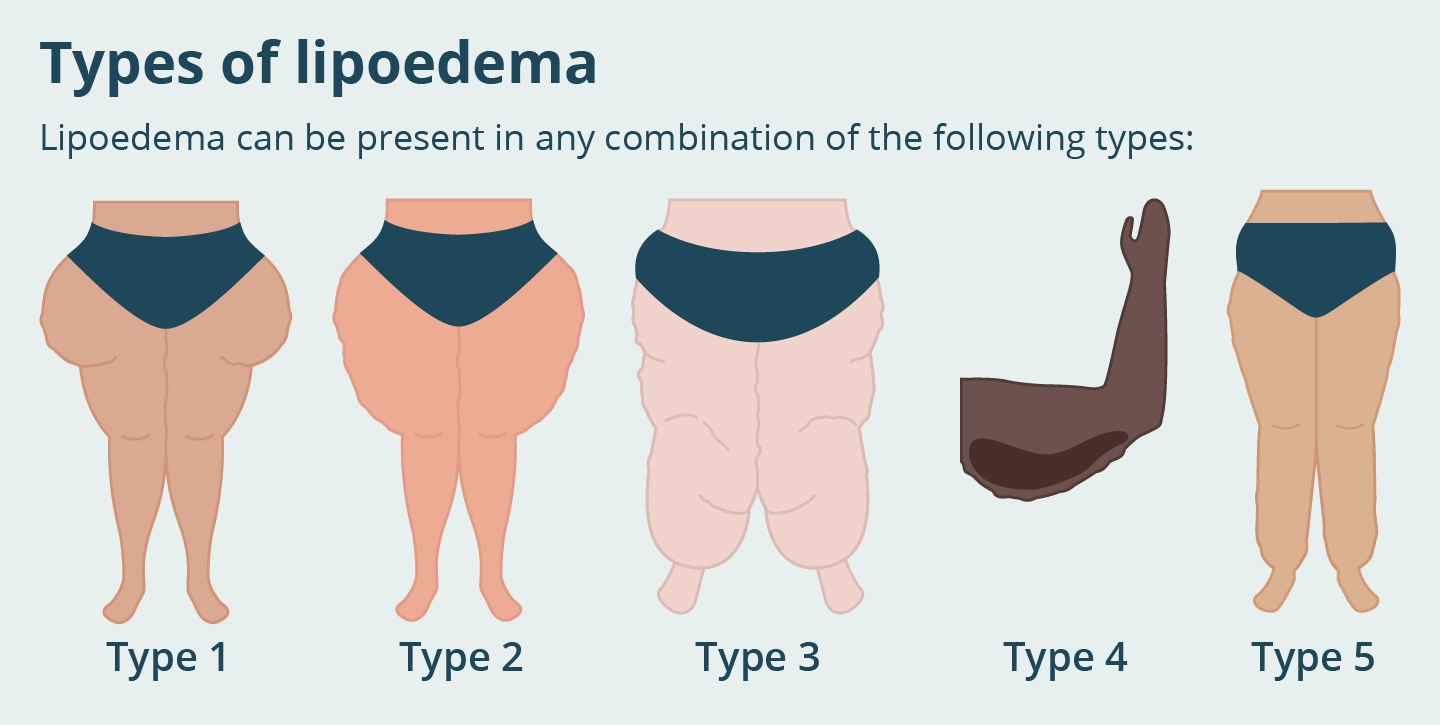 Illustration showing the 5 types of lipoedema: Type 1 buttocks and hips, Type 2 hips to the knees, Type 3 hips to ankles, Type 4 Upper arms, Type 5 calves.