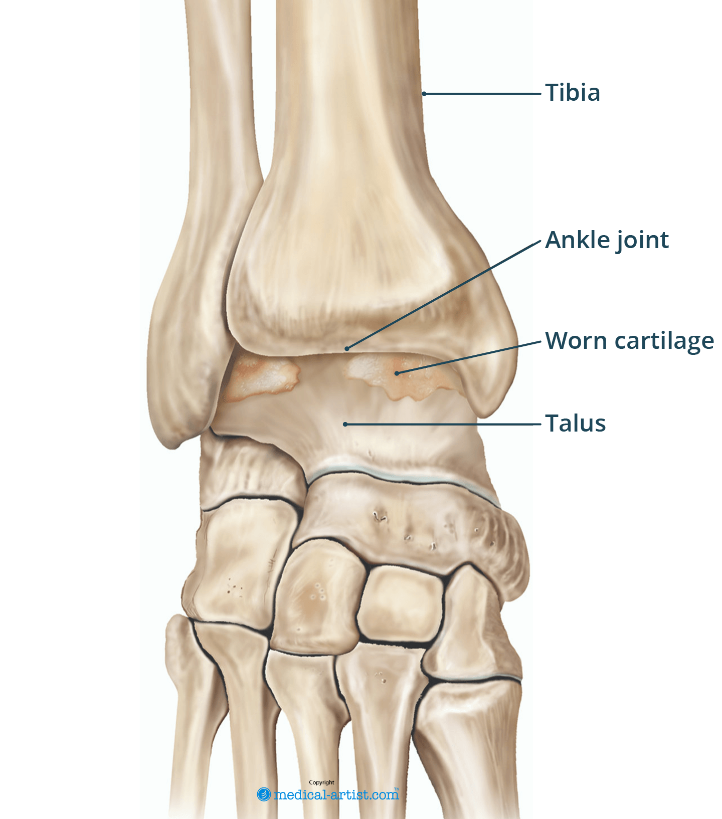 Illustration of the ankle bones (tibia, fibula and talus) showing worn cartilage on the joint surfaces, indicating ankle arthritis.