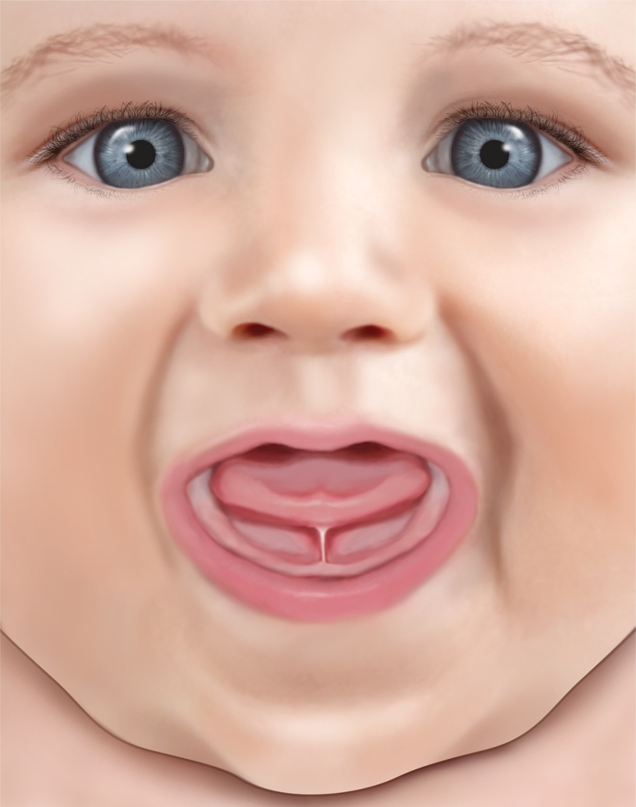 Illustration showing a tongue-tie.