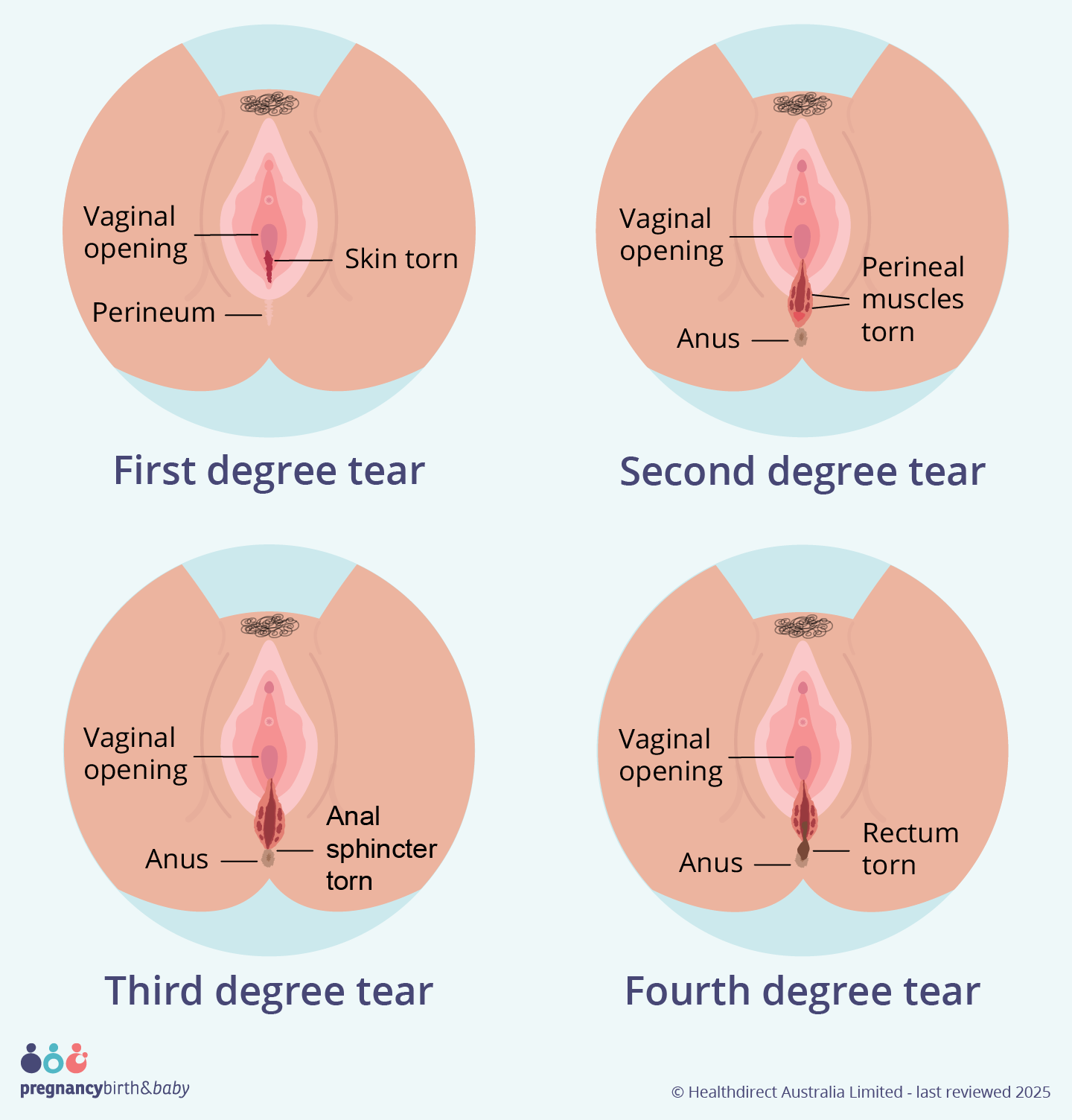 Illustration showing the four different degrees of perineal tears.