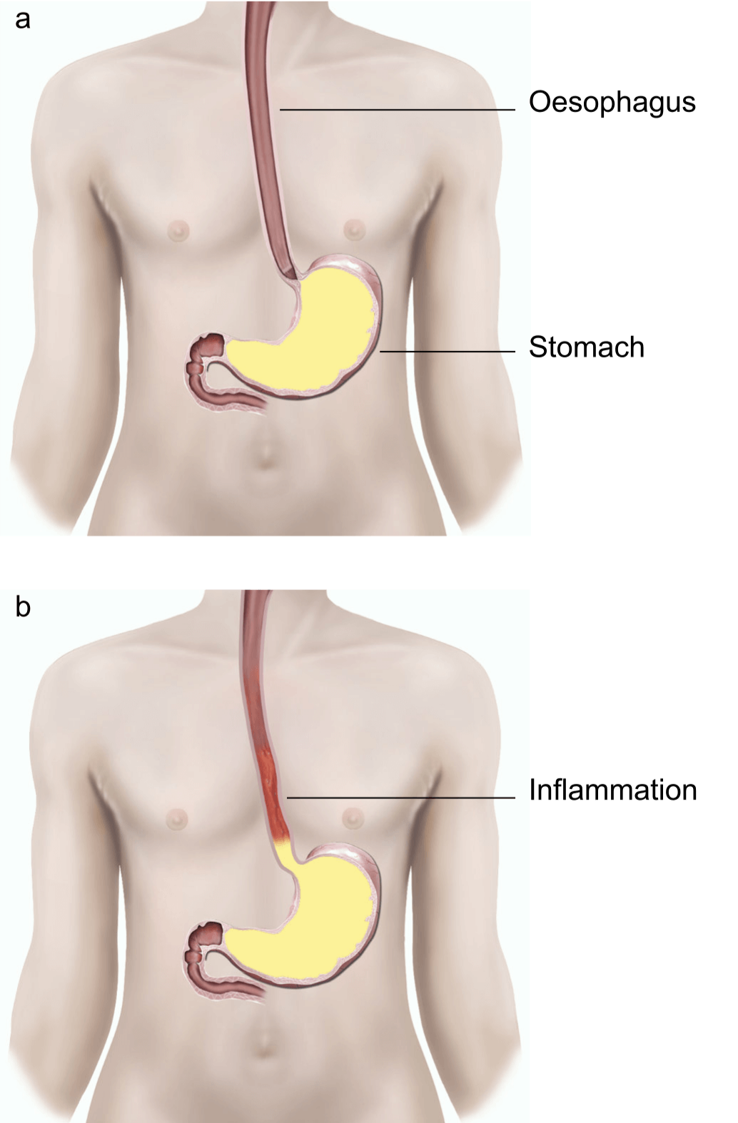 Illustration showing a normal valve and a faulty valve.