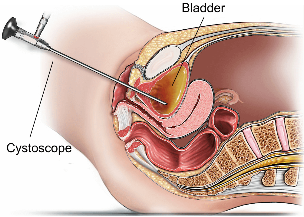 Illustration showing a rigid cystoscopy (female).