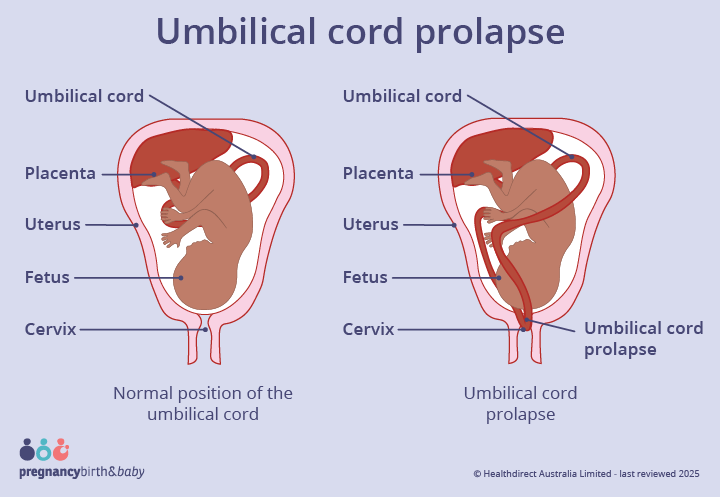 Illustration of an umbilical cord prolapse