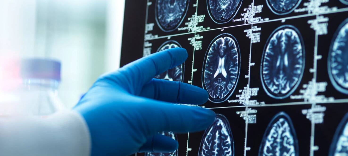 Brain scan image with a doctor's hand, representing medical diagnosis and research