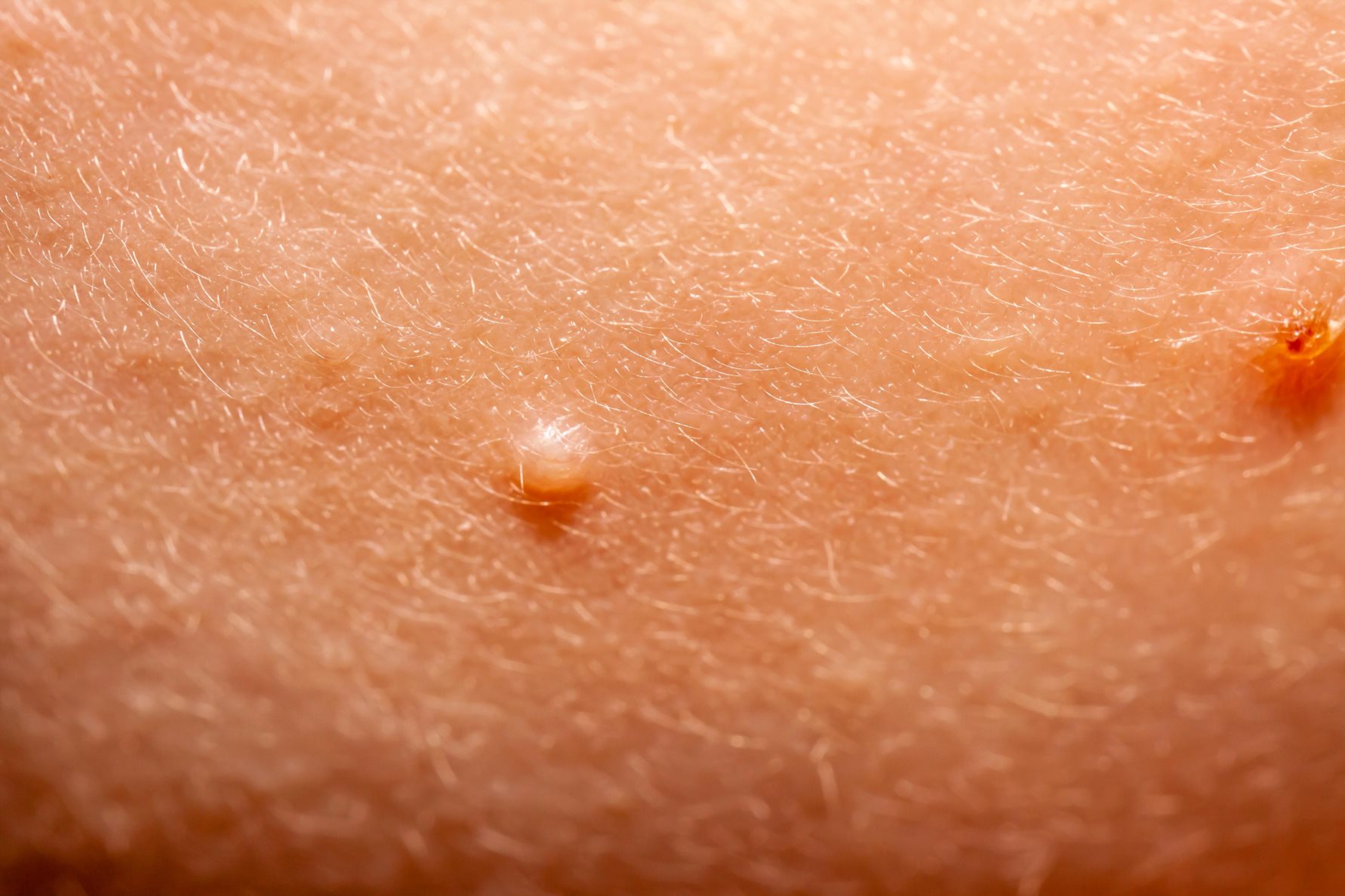Picture of molluscum contagiosum.