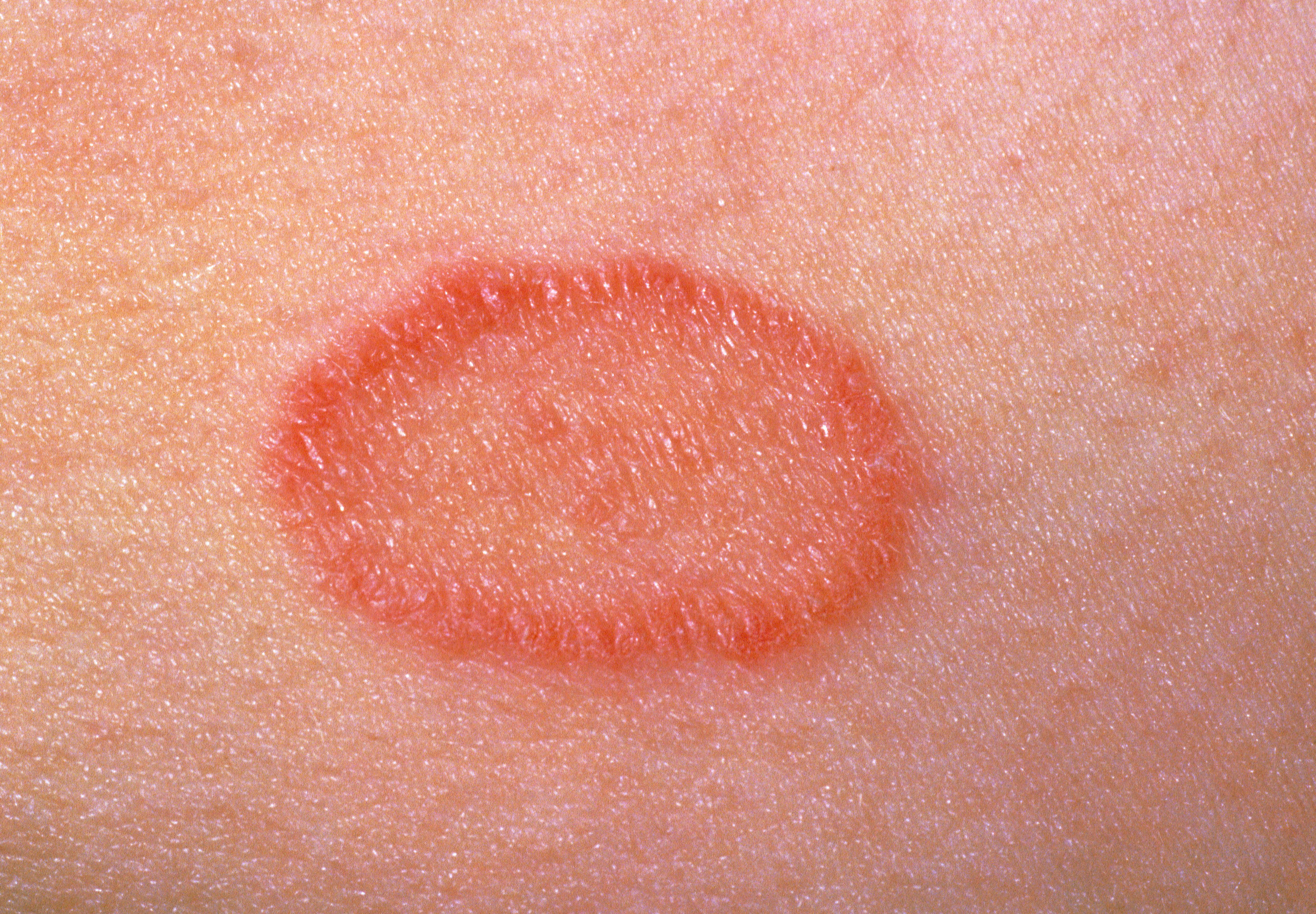 Close-up of pityriasis rosea on skin