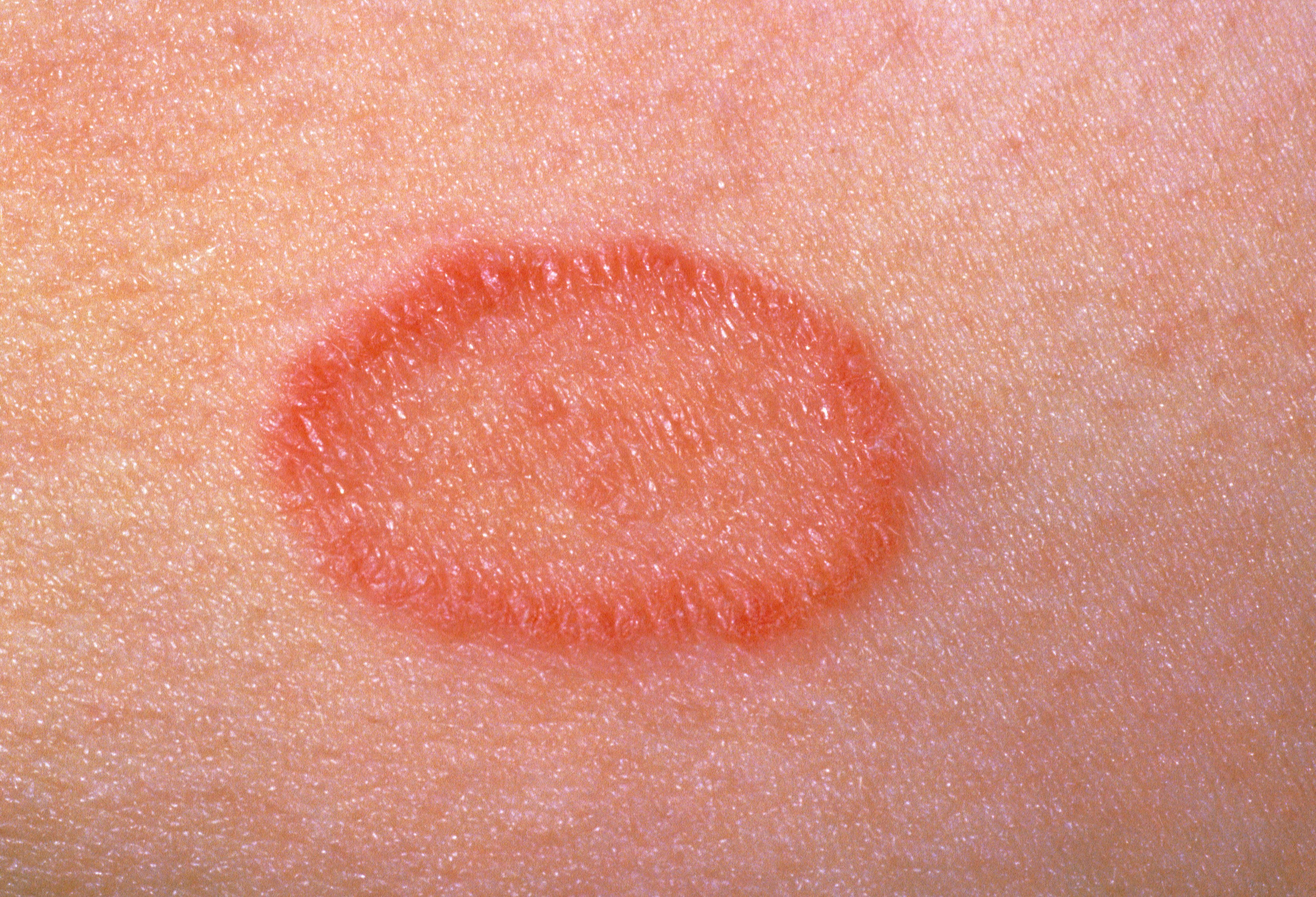 Close-up phtot of pityriasis rosea on skin