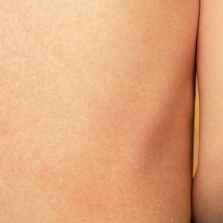 scarlet fever on a child's back