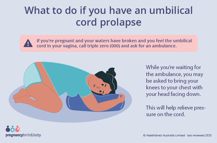 Illustration demonstrating the position you should stay in while waiting for an ambulance if you experience an umbilical cord prolapse.